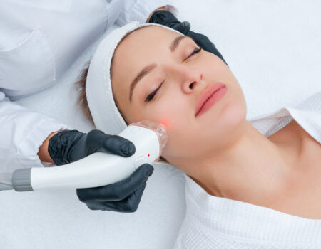 Laser resurfacing