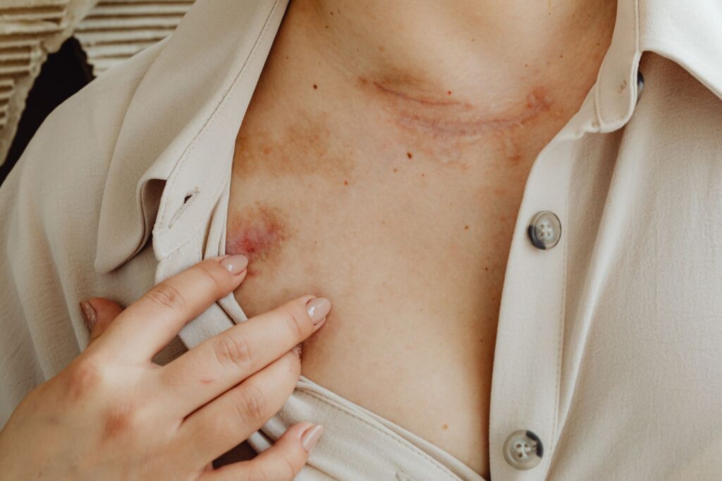 Close-up view of scarred skin on chest with a hand gently touching, symbolizing healing.